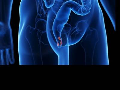 Miért jön ki az aranyér, és miért nem múlik el?