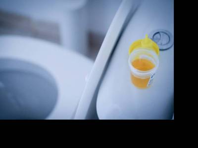 Milyen színű a reggeli vizelete? 